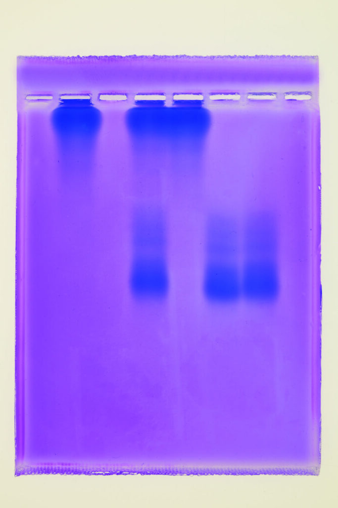 A sample of a purple tracking sheet from Ward's Science hemoglobin screening for Sickle-Cell lab activity